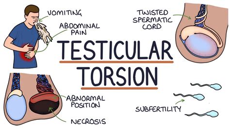 can you get testicular torsion twice|how serious is testicular torsion.